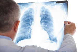 Rheumatoid arthritis affects lungs, raises risk of interstitial lung disease