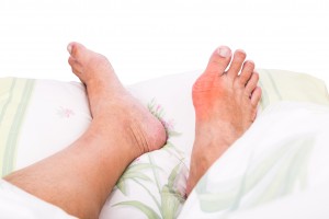 rheumatoid arthritis vs. gout