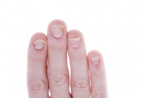 Nail psoriasis and psoriatic arthritis symptoms connected