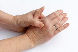 Rheumatoid arthritis