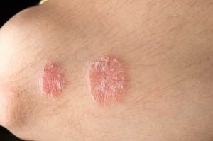 Psoriasis and psoriatic arthritis raise gout risk