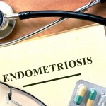 endometriosis-pelvic-pin-in-women-associated-with-poor-mental-health