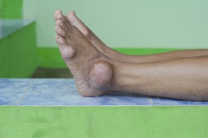 gout causes, symptoms, treatment and diagnosis