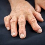 Rheumatoid Arthritis Pain