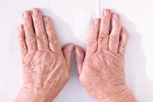 Causes and treatment for psoriatic arthritis