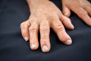 Mood affects pain rheumatoid arthritis