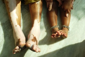 treatment for vitiligo