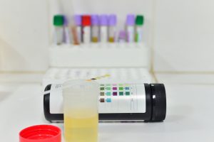 proteinuria protein in urine