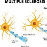 multiple sclerosis