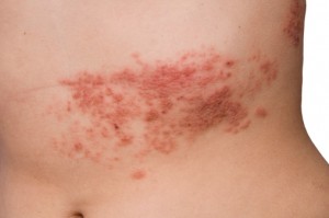 senior shingles patience unlikely to have recurrence of painful skin condition