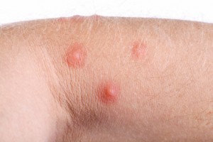 pimples on skin