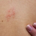 hives trigger