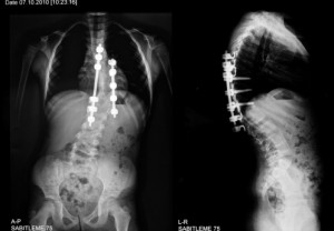 Scoliosis, an abnormal spine curvature in adolescence, may also affect older adults