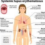 lupus information