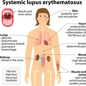 The majority of Americans know very little about lupus