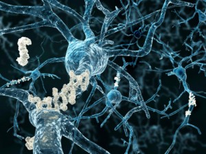 Understanding Alzheimer’s disease plaques in brain easier with amyloid protein cues