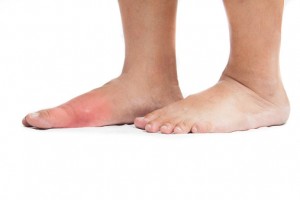 14 Natural remedies for gout pain relief