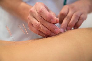 Acupuncture tops drugs for back pain relief: Study