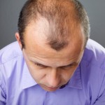 prevent-hair-loss