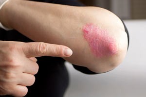 symptoms-of-psoriasis