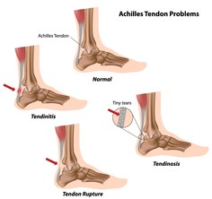 Achilles Tendon.jpg