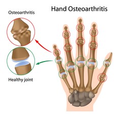 Hand Osteoarthritis.jpg