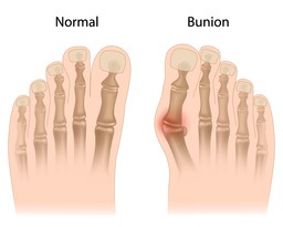 Bunion.jpg