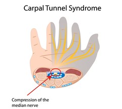 Carpal Tunnel