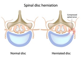 Herniated Disk.jpg