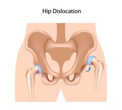Hip Dislocation.jpg