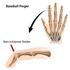 Baseball Finger.JPG