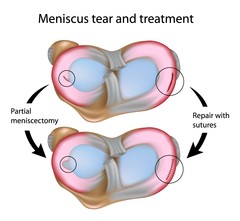 Meniscus.jpg