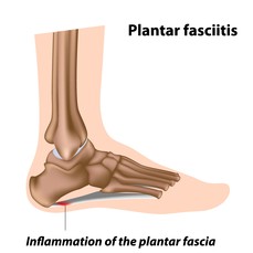 Plantar Fasciitis.jpg