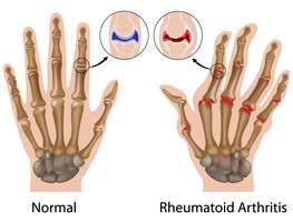 Rheumatoid Arthritis.jpg