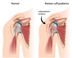 Rotator Cuff.JPG