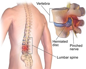 Lumbar