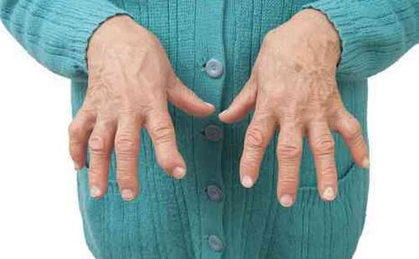 About Hand Arthritis