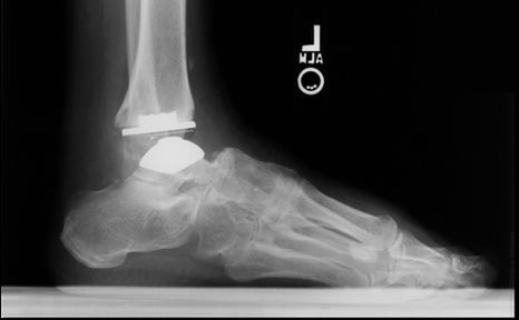 Total Ankle Arthroplasty Shows Promise