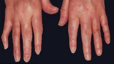 5 remedios caseros para la artritis reumatoide