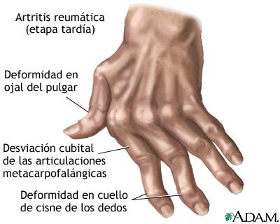 artritis