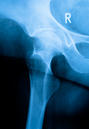 Enfermedades por aparatos. Huesos, articulaciones y músculos. Osteoporosis