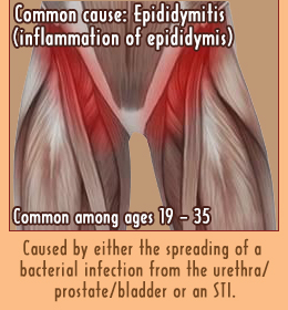 Groin pain in men